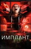 Имплант